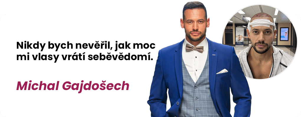Vlasy z Turecka - transplantace vlasů v Turecku - Michal Gajdošech